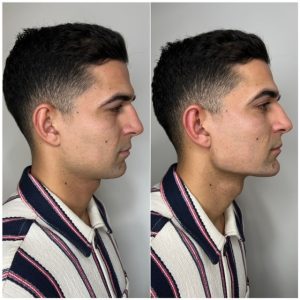 Before and After Jawline Filler 2