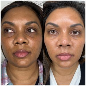 Before and After Facial Rejuvenation 2